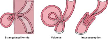 Esophagus Cancer Blockage